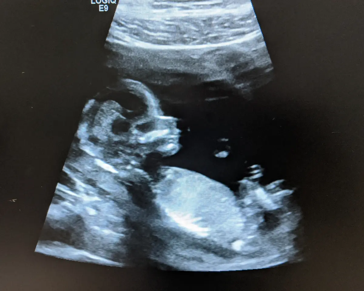 Ultrasound scan showing developing baby, representing healthy placenta and blood supply during pregnancy.